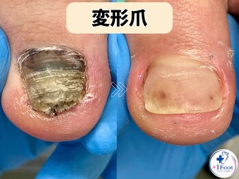 プラスワンフット 本厚木(+1 Foot)/変形・肥厚した爪を正常な爪へ