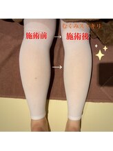 アルバ 広島店(ALBA)/エンダモロジー〈むくみ〉