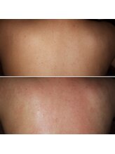 ミラージュ(mirage)/背中ワックス脱毛