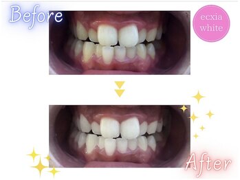 エクシアホワイトニング 明石店/ビフォーアフター