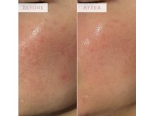 アンドニューリー(&NEWLY)/水玉リフティング　Before After