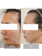 シンユウ(Shinyou)/美肌改善フェイシャル →8ヶ月後