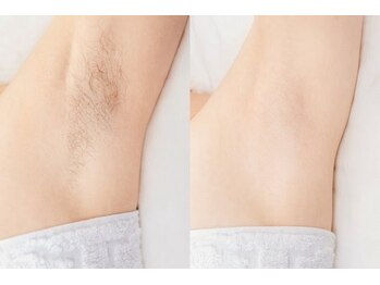 【袋井の美肌脱毛サロン】yamaki/脱毛効果を実感