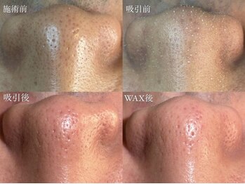 リュクスルーム(Luxe room)/３D毛穴洗浄×潤艶WAX脱毛１回