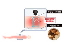 コアヒートは深部から加温する、対極版付きラジオ波です