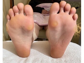 フットケア・角質ケアはビサンテ
