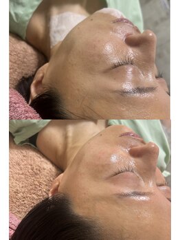 マホロバ(mahoroba)/美容鍼×ララピール(マホロバ)