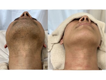 ビオエル(Bioel)/Before After