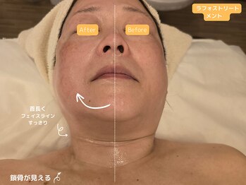 エントテ(en to Te)/ラフォス立体小顔&リフトアップ