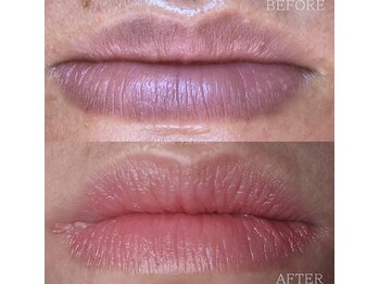 ローマサロン/20日でこの変化☆ローマピンク