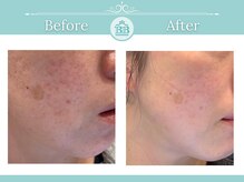 ゼロ美人 那覇店(ZERO美人)/【シミケア★シミケアZERO美人】