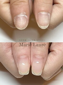 マリーロール 梅田店(Marie Laure)/深爪矯正/自爪育成/ネイルケア
