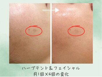 こもれび/温活×フェイシャルの変化