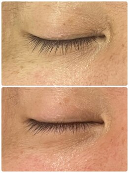 マニス(manis)/ヒト幹細胞培養液