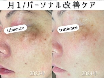 トリニエンス 新宿店(TRINIENCE)/40代/シミケア/目元頬沈着ケア