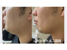 オウカ(OUKA)/話題の脂肪分解剤レモンボトル