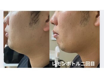 オウカ(OUKA)/話題の脂肪分解剤レモンボトル