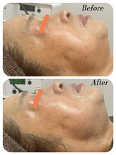 ワンバイゼロ(One by zero)/ハーブピーリング4回目