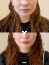 ロンルナール(Rond Renard)/