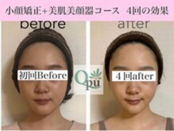 キュープ 福岡九大学研都市店(Qpu)/美顔器モニターコース４回の変化