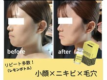 エステティックサロン さら/小顔　レモンボトル