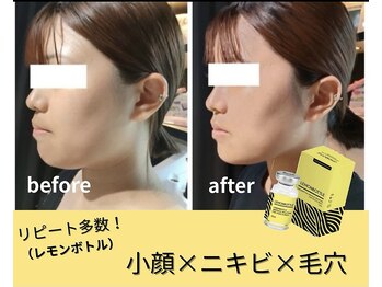 エステティックサロン さら/小顔　レモンボトル