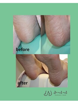 ふっとっと/かかとケア before after