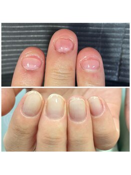 ツメヤ(TSUMEYA)/深爪・噛み爪さんも◎