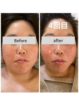 ミピマムマール(Mipimam Maaru)/お客様before→after