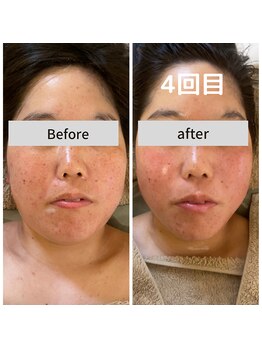 ミピマムマール(Mipimam Maaru)/お客様before→after