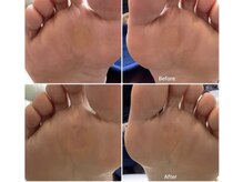 リゼラアンドコー 宇都宮店/タコ/角質ケア、Before＆After