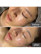 ロッタ エクリュ(Lotta ecru+)/お顔につや玉☆ハーブピーリング