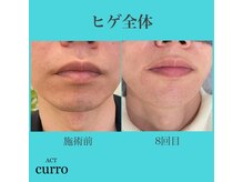 アクト クロ(ACT curro)/【ヒゲ全体】脱毛施術例