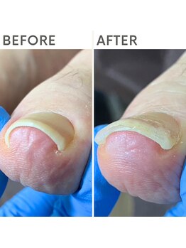 クオッカ(Quokka)/巻き爪ケア