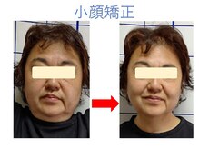 マインドボディ コモレビ(MIND BODY Komorebi)の雰囲気（【小顔矯正】一度でアゴのたるみを一気に改善！本人も大満足♪）