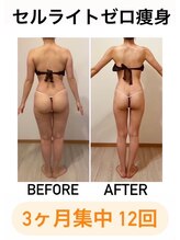 カルナ(CARNA)/【痩身】セルライトゼロ2