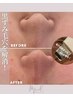 夏のザラつきも黒ずみ毛穴も解消!大人気◎毛穴洗浄+角質トリートメント付