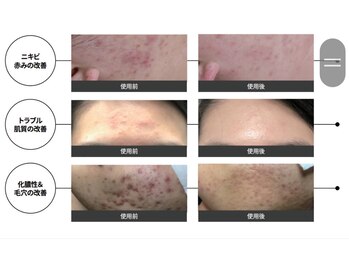 ユフラ(Juhla)/韓国式ハーブピーリング