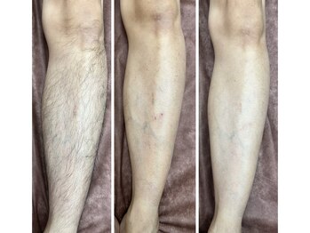 パンダの脱毛サロン/施術前～5回目まで