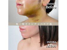 術後の女神 大阪本町店/ダウンタイムケア・インディバ