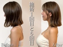 ウィーブ(WIIVE)/「2ヶ月施術後」の巻き肩