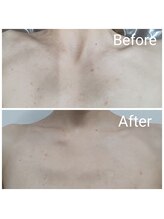 レン(Ren)/ハーブピーリング（デコルテ）