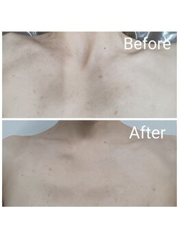 レン(Ren)/ハーブピーリング（デコルテ）