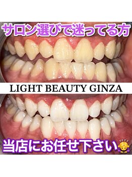 ライトビューティー 銀座店(LightBeauty)/東銀座　ホワイトニング症例写真