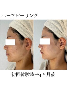 イム(I'm.)/ハーブピーリング before/after