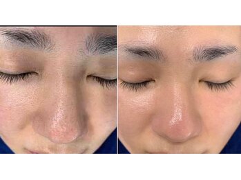 大場はりきゅう接骨院 整体院/【美容鍼】