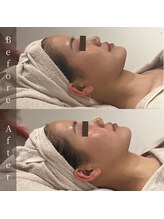 インフィニーズ(INFINEEZ)/カスタマイズ120分美肌改善20代