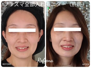 しみ改善サロン リフィーナ/内側からハリ艶アップ