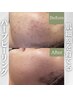 《ニキビ》陶肌トリートメント+ニキビ特化オプション