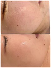 ミラ(Mila)/毛穴洗浄　BeforeAfter